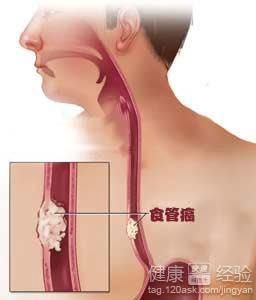 阑尾炎一个月了还是疼阑尾炎术后一月余仍疼痛不止，原因与应对策略